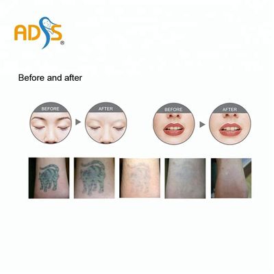 Laser Pico Laser Tattoo Removal Machine 1064nm 532nm del ND commutato Q Yag